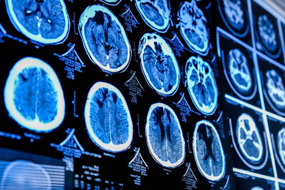 Brain CT scans showing potential neurological injuries linked to Florida medical malpractice claims